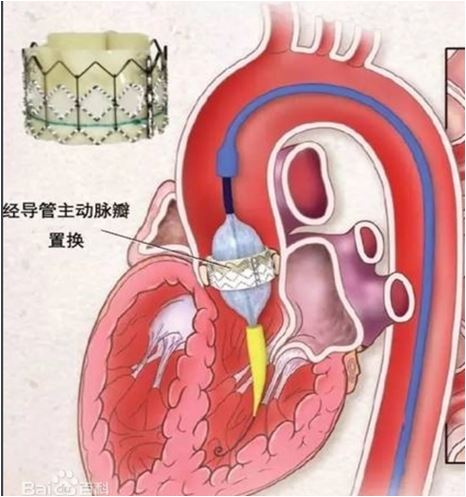 腰椎间盘突出怎么冶