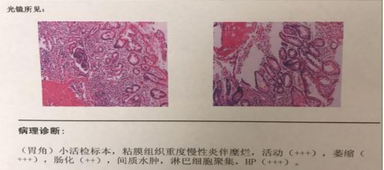 腰椎间盘突出怎么冶