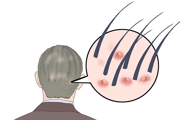 腰椎间盘突出能顺产吗