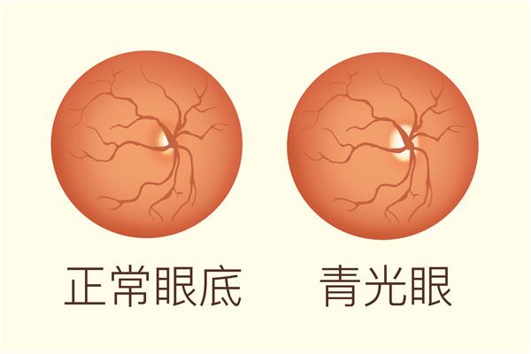 腰椎间盘突出怎么冶