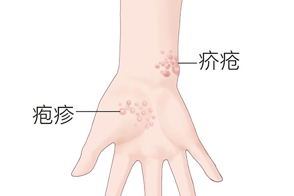 肘部起皮干裂怎么办