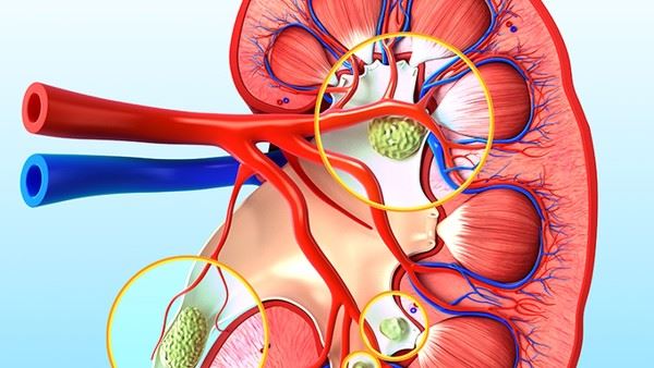 肾积水的常见原因？